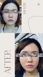 Silvia LuxRF™ V-FaceLift and Tightening - 60min